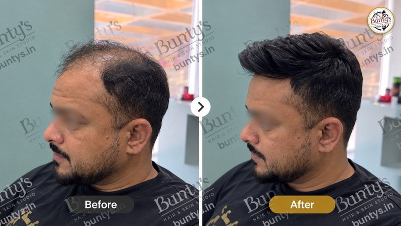 Before and after hair replacement for thinning hair on the front and top, short textured style, at Bunty's, Old Padra Road Vadodara