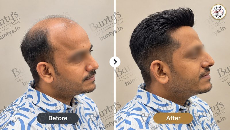 Side view before and after hair replacement for a receding hairline, styled with volume in front, at Bunty's, Old Padra Road Vadodara