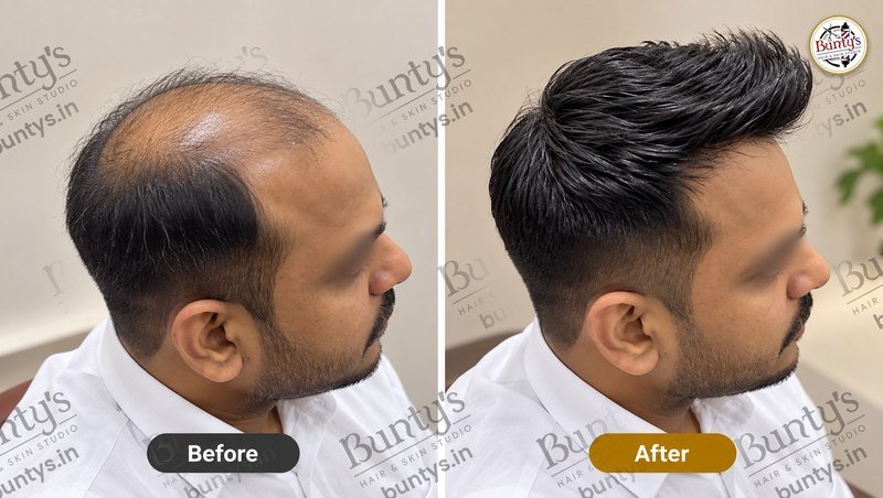 Before and after hair system for thinning on top, full textured style, at Bunty's, Old Padra Road Vadodara