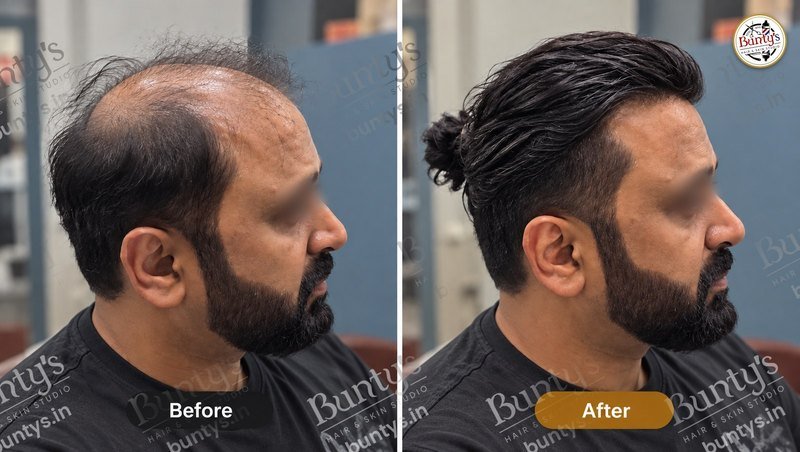 Before and after hair replacement for a bearded client with thinning on top, longer hair tied back, at Bunty's, Old Padra Road Vadodara