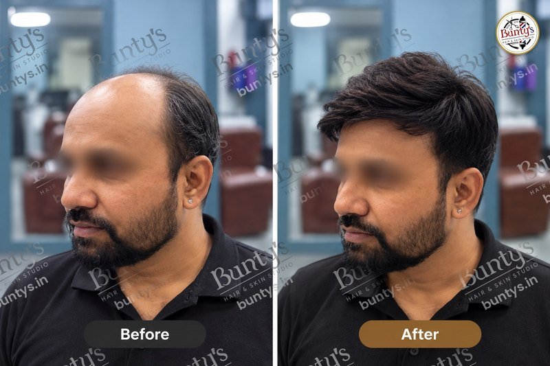Before and after hair replacement for a bearded client with a bald top, natural short style, at Bunty's, Old Padra Road Vadodara